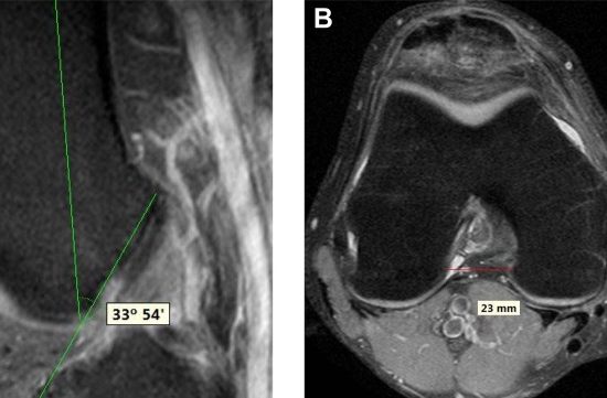 The importance of the intercondylar nothc in anterior cruciate ligament tears