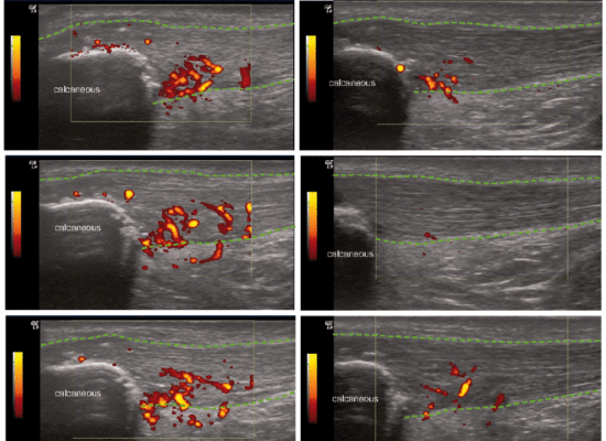 Case Report: Efficacy of dobesilate in insertional Achilles tendinopathy