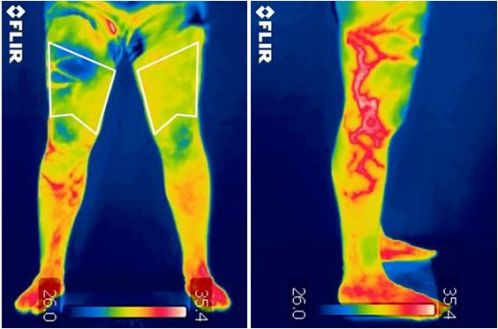 Infrared thermography as a support tool for screening and early diagnosis in emergencies