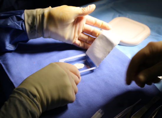 El Implante de Condrocitos Autólogos es una técnica eficaz para tratar lesiones de cartílago del tobillo