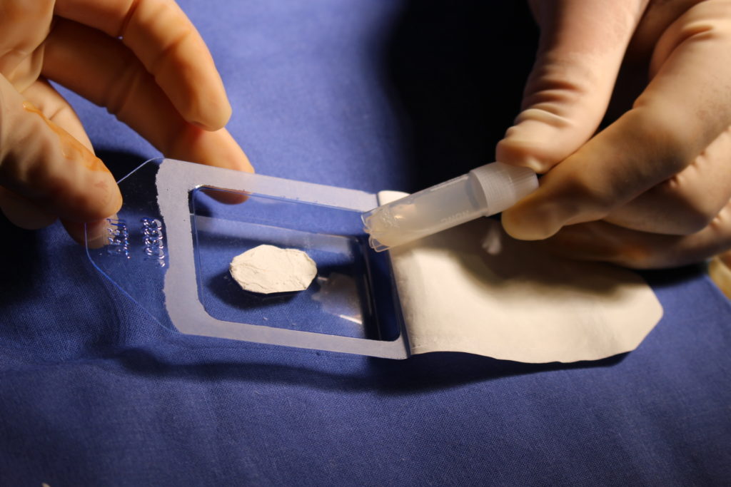 osteocondritis_opciones_quirurgicas