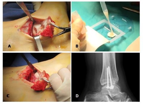 High-Density Autologous Chondrocyte Implantation as Treatment for Ankle Osteochondral Defects